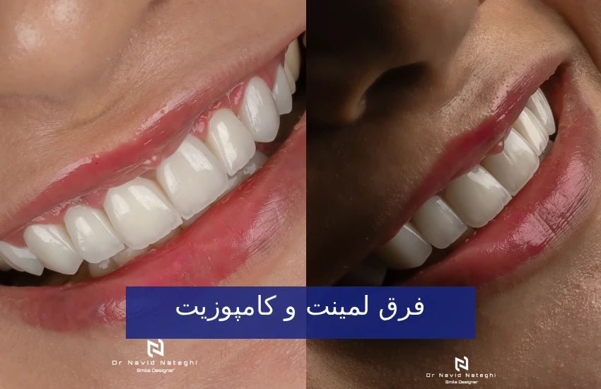 تفاوت‌های لمینت و کامپوزیت دندان