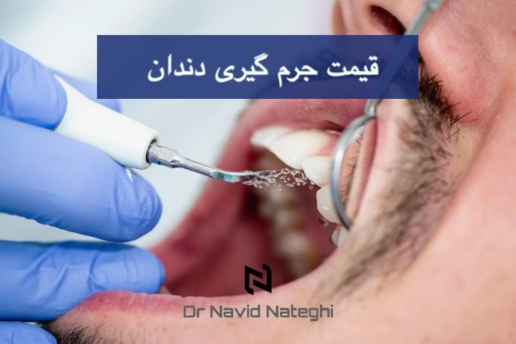 قیمت جرم گیری دندان