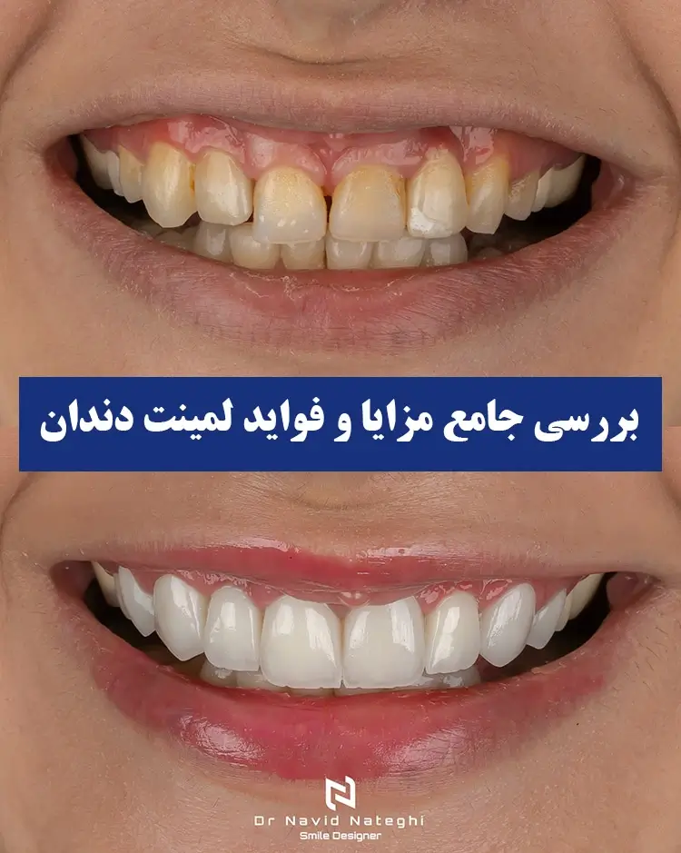 بررسی جامع مزایا و فواید لمینت دندان