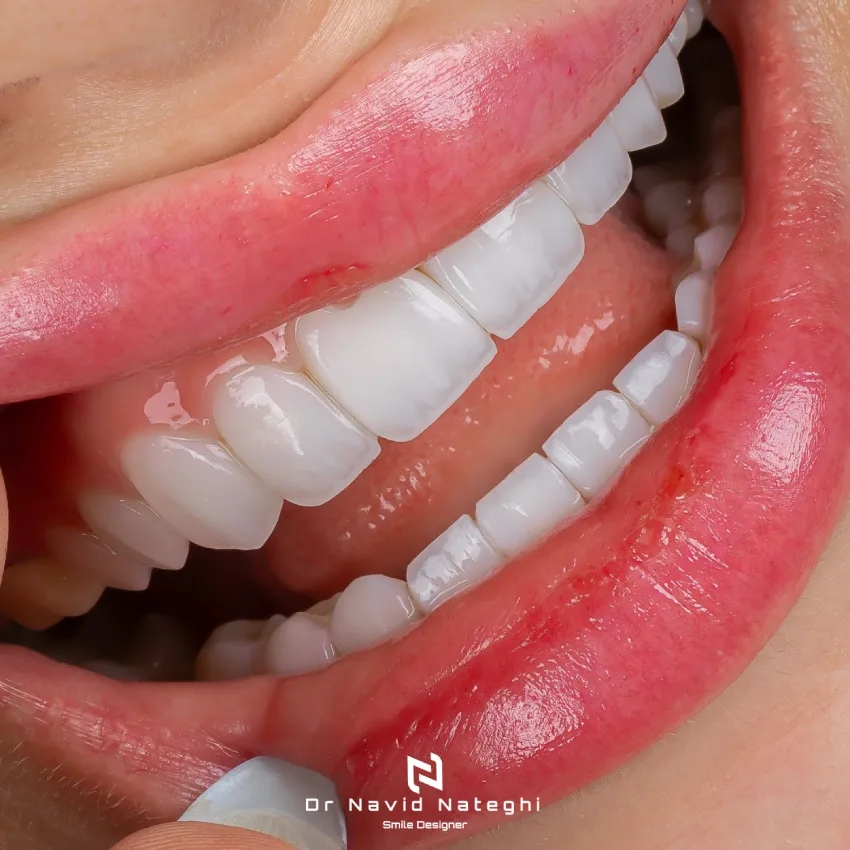 كامپوزيت ips چيست؟ کامپوزیت ips چیه؟