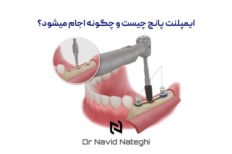 ایمپلنت پانچ چیست و چگونه اجام میشود؟