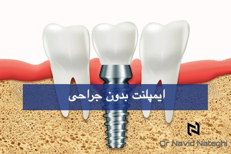 ایمپلنت بدون جراحی چیست؟