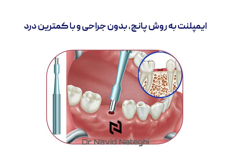 ایمپلنت به روش پانچ، بدون جراحی و با کمترین درد