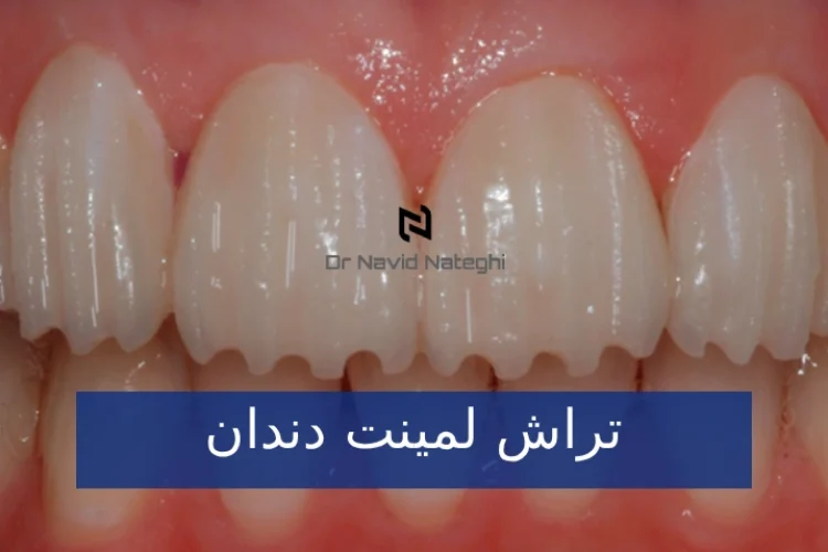 تراش لمینت دندان : مراحل , میزان و نحوه تراش دندان برای لمینت