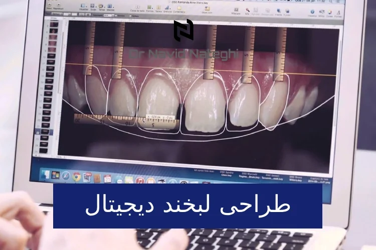 طراحی لبخند دیجیتال (DSD) : طراحی لبخند با کامپیوتر