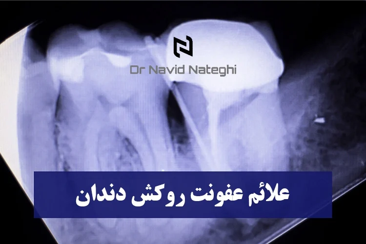 علائم عفونت روکش دندان : راه‌های پیشگیری و درمان