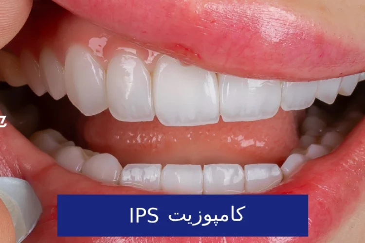 کامپوزیت IPS : معرفی کامل برند ، مراحل ، رنگ‌ها و انواع آن